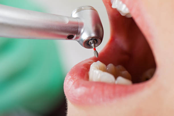 Best Emergency Wisdom Tooth Extraction in Battlefield, MO